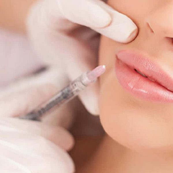 Fillers di acido ialuronico